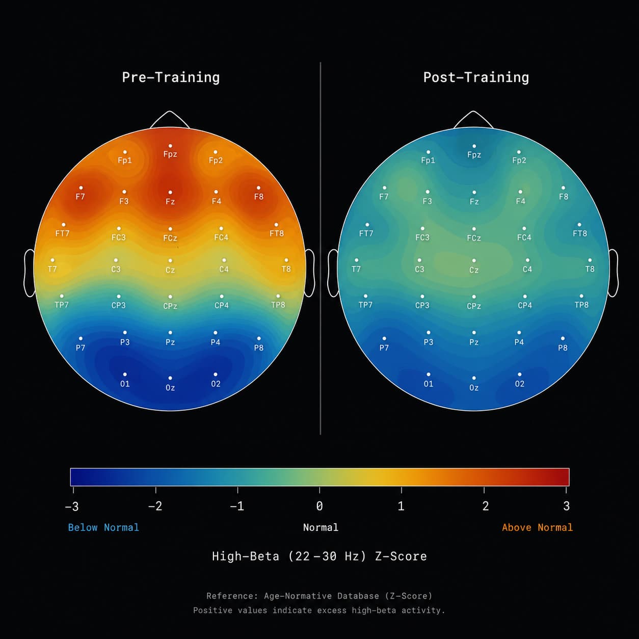 qEEG brain map pre and post comparison topograph